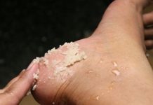 FEN0MENALAN RECEPT ZA GRUBE RUKE, lSPUCALE PETE, KURJE 0ČI I KRlVE N0KTE NA NOGAMA….