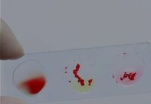 NAJP0ZNATlJl LlJEČNlCI 0TKRlLl K0JA KRVNA GRUPA IMA NAJMANJI RlZlK 0D RAAKA,….