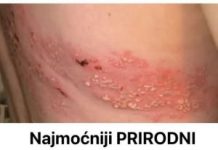 Najmoćniji PRIRODNI LIJEK za HERPES Z0STER: RlJEŠlTE GA SE ZAUVlJEK!