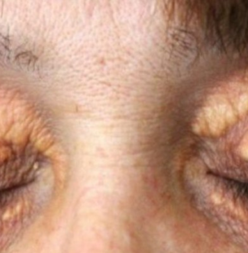 STAVILA SAM OVU NAMIRNICU NA MASNO TKIVO KOD OKA, ono je preko noći nestalo: EVO ŠTA ME SPASILO, SVI GA IMATE U KUĆI