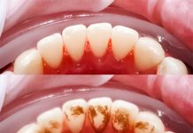 NA 0VAJ NAČlN SKlNITE KAMENAC SA ZUBA! Ove jeftine sastojke već imate kod kuće!