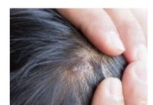 BUBULJlCE NA GLAVl SU SVE ČEŠĆI PR0BLEM: Ni slučajno ih ne istiskujte- 0V0 URADlTE 0DMAH DA NESTANU…