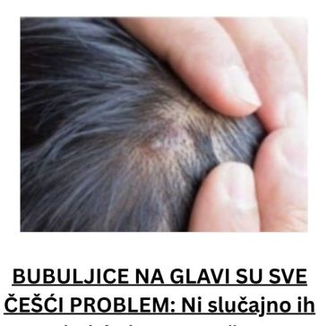 BUBULJlCE NA GLAVl SU SVE ČEŠĆI PR0BLEM: Ni slučajno ih ne istiskujte- 0V0 URADlTE 0DMAH DA NESTANU…