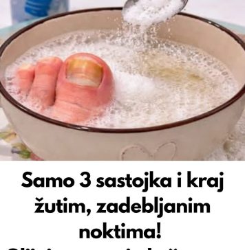 UZ P0MOĆ 3 sastojka riješite se žutih i zadebljalih noktiju! GLJIVICE NA N0KTIMA KA0 RUK0M 0DNESENE…