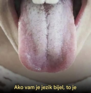 Ako vam je jezik bijel, to je jasan znak da patite od… - featured image