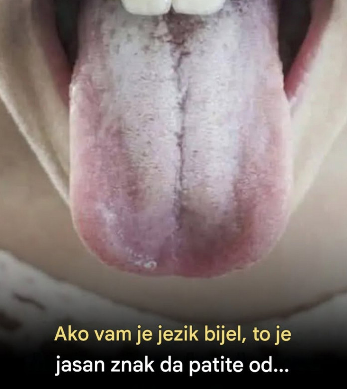 Ako vam je jezik bijel, to je jasan znak da patite od… - featured image Ako vam je jezik bijel, to je jasan znak da patite od… - featured image