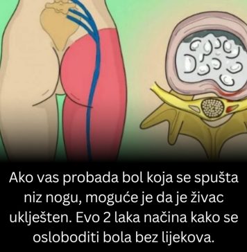 Ako vas probada bol koja se spušta niz nogu, moguće je da je živac uklješten. Evo 2 laka načina kako se osloboditi bola bez lijekova. Ako vas probada bol koja se spušta niz nogu, moguće je da je živac uklješten. Evo 2 laka načina kako se osloboditi bola bez lijekova. - featured image