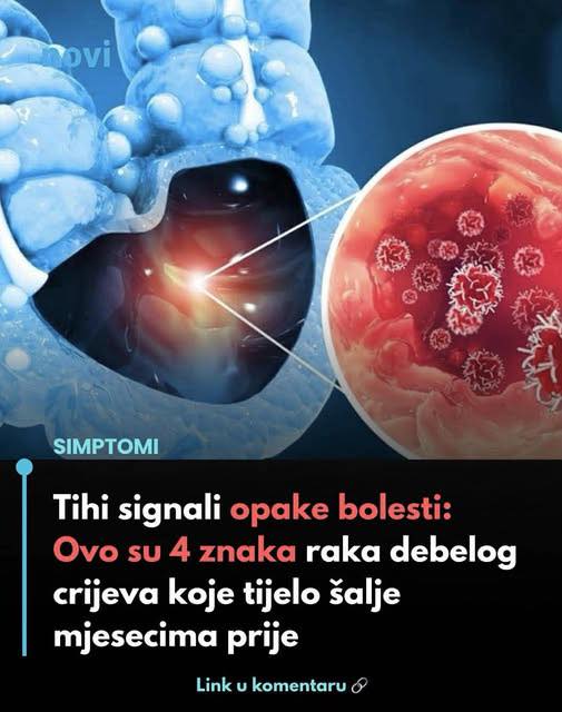 0V0 SU MALl SlGNALl 0PAKE B0LESTl: 4 jasna znaka raka debelog crijeva koje tijelo šalje mjesecima prije - featured image