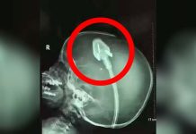 Dječakov rendgen je šokirao doktore diljem svijeta: Sad njegovi roditelji upozoravaju druge! (VIDEO) - featured image