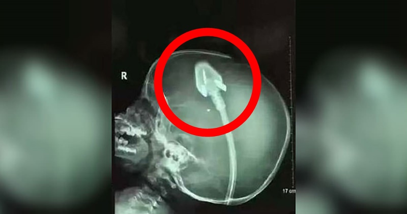Dječakov rendgen je šokirao doktore diljem svijeta: Sad njegovi roditelji upozoravaju druge! (VIDEO) - featured image Dječakov rendgen je šokirao doktore diljem svijeta: Sad njegovi roditelji upozoravaju druge! (VIDEO) - featured image