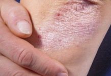 NE BACAJTE NI SLUČAJNO KORU OD OVE VOĆKE: Liječi Psorijazu, Skida Bradavice I Izbjeljuje Zube! - featured image