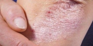 NE BACAJTE NI SLUČAJNO KORU OD OVE VOĆKE: Liječi Psorijazu, Skida Bradavice I Izbjeljuje Zube! - featured image