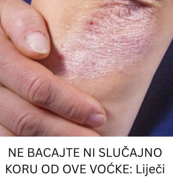 NE BACAJTE NI SLUČAJNO KORU OD OVE VOĆKE: Liječi Psorijazu, Skida Bradavice I Izbjeljuje Zube! NE BACAJTE NI SLUČAJNO KORU OD OVE VOĆKE: Liječi Psorijazu, Skida Bradavice I Izbjeljuje Zube! - featured image