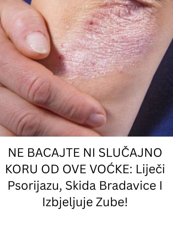 NE BACAJTE NI SLUČAJNO KORU OD OVE VOĆKE: Liječi Psorijazu, Skida Bradavice I Izbjeljuje Zube! - featured image