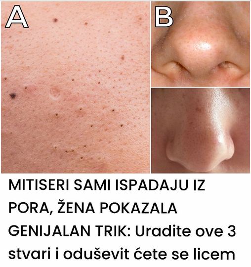 MITISERI SAMI ISPADAJU IZ PORA, ŽENA POKAZALA GENIJALAN TRIK: Uradite ove 3 stvari i oduševit ćete se licem - featured image