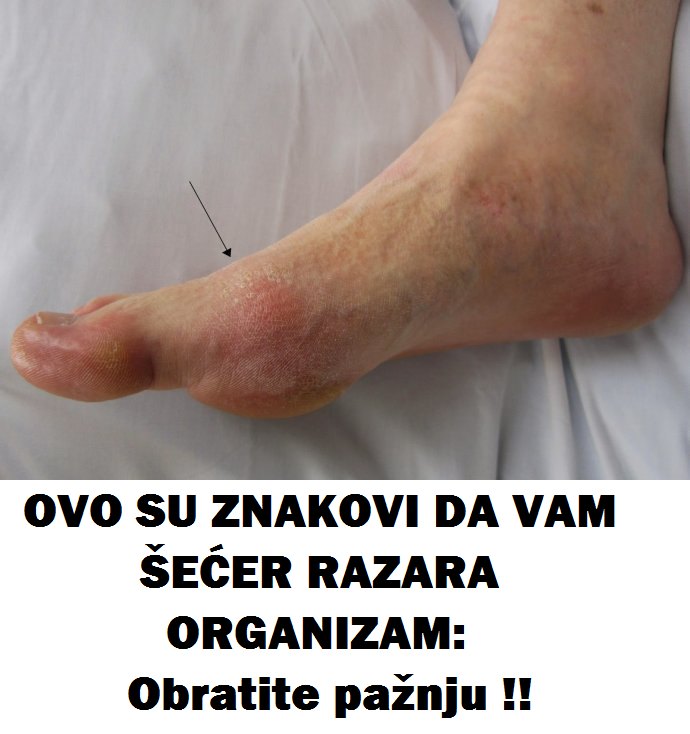 OVO SU ZNAKOVI DA VAM ŠEĆER RAZARA ORGANIZAM: Obratite pažnju - featured image OVO SU ZNAKOVI DA VAM ŠEĆER RAZARA ORGANIZAM: Obratite pažnju - featured image