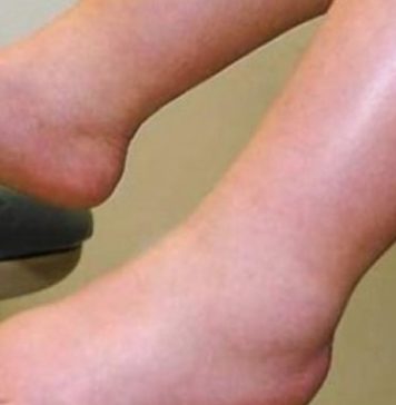 DA IZBACITE VIŠAK VODE POTREBAN VAM JE JEDAN VITAMIN: Ni noge vam više neće oticati, samo ga ubacite u ishranu - featured image