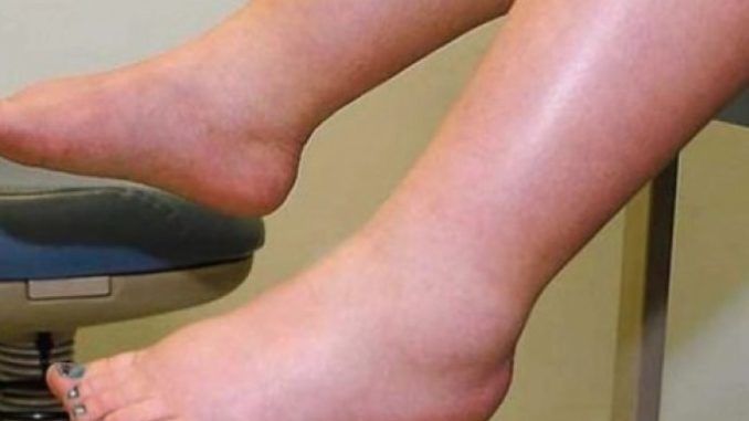 DA IZBACITE VIŠAK VODE POTREBAN VAM JE JEDAN VITAMIN: Ni noge vam više neće oticati, samo ga ubacite u ishranu - featured image