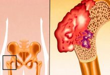 Bol u kostima, visok pritisak i tuga: Tijelo vam govori da mu NEDOSTAJE ovaj važan VITAMIN Bol u kostima, visok pritisak i tuga: Tijelo vam govori da mu NEDOSTAJE ovaj važan VITAMIN - featured image