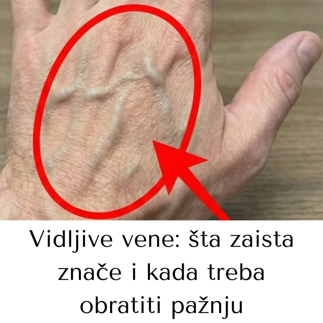 Ako imaš vidljive vene, to značI da si… - featured image