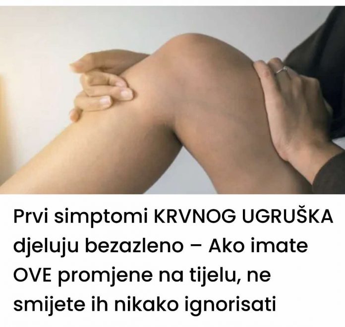 Prvi simptomi KRVNOG UGRUŠKA djeluju bezazleno – Ako imate OVE promjene na tijelu, ne smijete ih nikako ignorisati - featured image