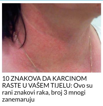10 ZNAKOVA DA KARCINOM RASTE U VAŠEM TIJELU: Ovo su rani znakovi raka, broj 3 mnogi zanemaruju - featured image