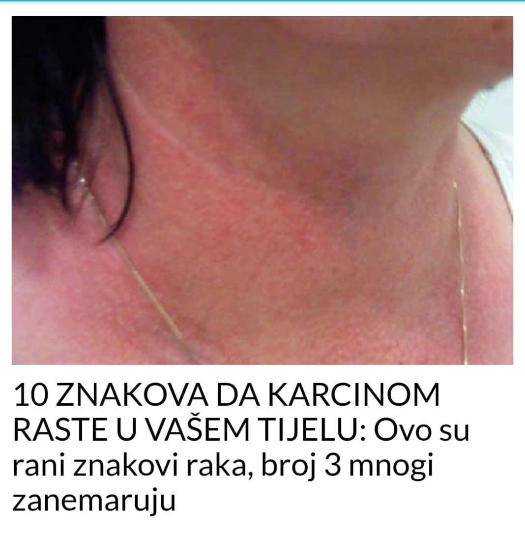 10 ZNAKOVA DA KARCINOM RASTE U VAŠEM TIJELU: Ovo su rani znakovi raka, broj 3 mnogi zanemaruju - featured image