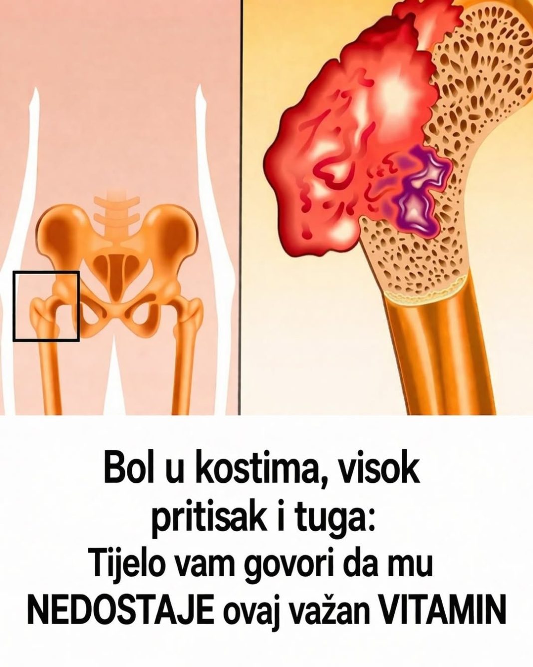 Bol u kostima, visok pritisak i tuga: Tijelo vam govori da mu NEDOSTAJE ovaj važan VITAMIN - featured image