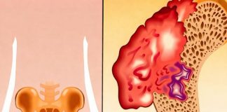 Bol u kostima, visok pritisak i tuga: Tijelo vam govori da mu NEDOSTAJE ovaj važan VITAMIN - featured image