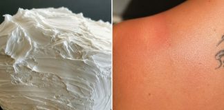 Izgorela je na suncu, a ovo ju je spasilo za 30 minuta: Svi to imamo u kući, a nije jogurt - featured image