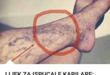 Svatko kod kuće ima lijek za popucale kapilare, ali mnogi ljudi to ne znaju! - featured image