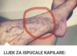 Svatko kod kuće ima lijek za popucale kapilare, ali mnogi ljudi to ne znaju! Svatko kod kuće ima lijek za popucale kapilare, ali mnogi ljudi to ne znaju! - featured image