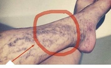 Svatko kod kuće ima lijek za popucale kapilare, ali mnogi ljudi to ne znaju! Svatko kod kuće ima lijek za popucale kapilare, ali mnogi ljudi to ne znaju! - featured image
