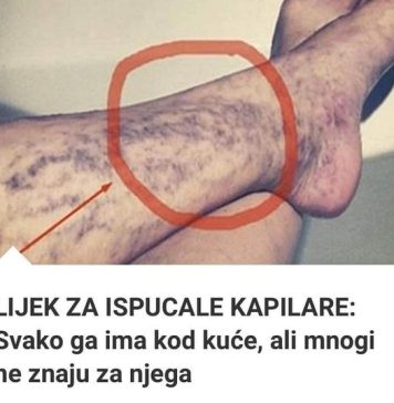Svatko kod kuće ima lijek za popucale kapilare, ali mnogi ljudi to ne znaju! - featured image