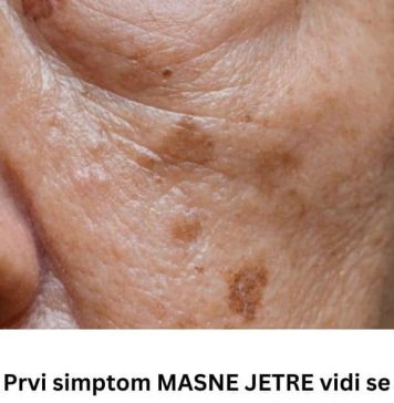Prvi simptom MASNE JETRE vidi se na LICU obolelog – Znojenje i loš dah se najlakše prepoznaju, ali ove SIGNALE tela mnogi - featured image