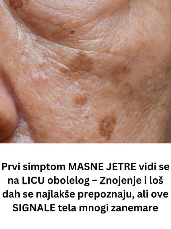 Prvi simptom MASNE JETRE vidi se na LICU obolelog – Znojenje i loš dah se najlakše prepoznaju, ali ove SIGNALE tela mnogi - featured image