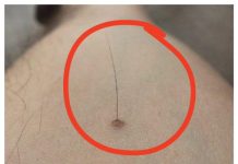 Evo šta tačno znači kada vam iz mladeža raste dlaka: Da li je to opasno, iznenadit ćete se - featured image