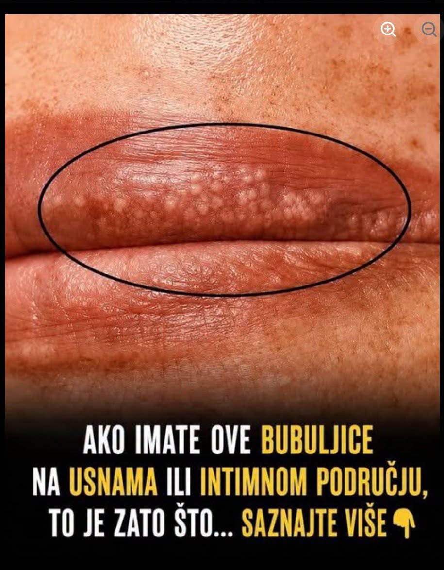 Bele fleke na usnama ili intimnom području? Ne ignorišite ove znake upozorenja! - featured image