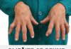 RIJEŠITE SE REUME ZAUVIJEK: Niti jedan lijek joj nije pomogao da izliječi REUMU, a onda je primjenila ovaj recept i ZAUVIJEK riješila svoj problem! - featured image