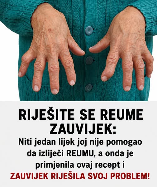 RIJEŠITE SE REUME ZAUVIJEK: Niti jedan lijek joj nije pomogao da izliječi REUMU, a onda je primjenila ovaj recept i ZAUVIJEK riješila svoj problem! - featured image RIJEŠITE SE REUME ZAUVIJEK: Niti jedan lijek joj nije pomogao da izliječi REUMU, a onda je primjenila ovaj recept i ZAUVIJEK riješila svoj problem! - featured image
