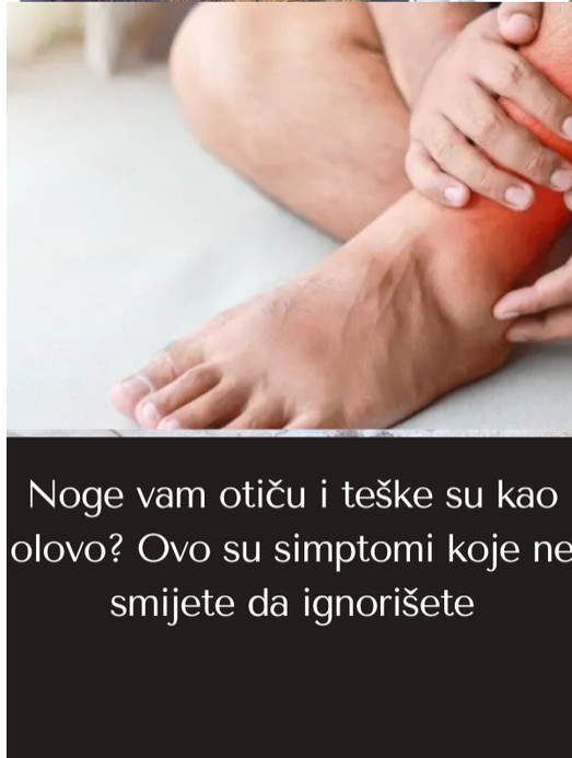 Noge vam otiču i teške su kao olovo? Ovo su simptomi koje ne smijete da ignorišete - featured image