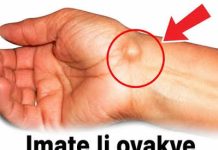 IMATE LI OVAKVE IZRASLINE: Evo kako da ih se riješite PREKO NOĆI