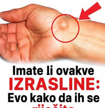 IMATE LI OVAKVE IZRASLINE: Evo kako da ih se riješite PREKO NOĆI